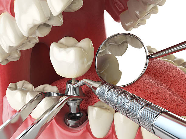 Best Emergency Root Canal Treatment in Two Harbors, MN